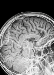 Neurological Impairment